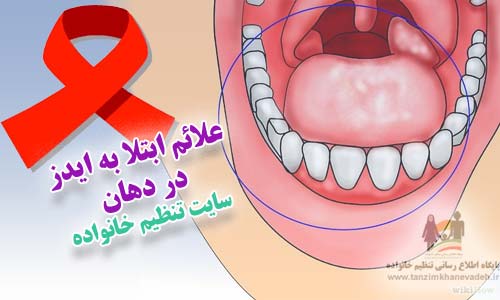 علائم ابتلا به ایدز در دهان